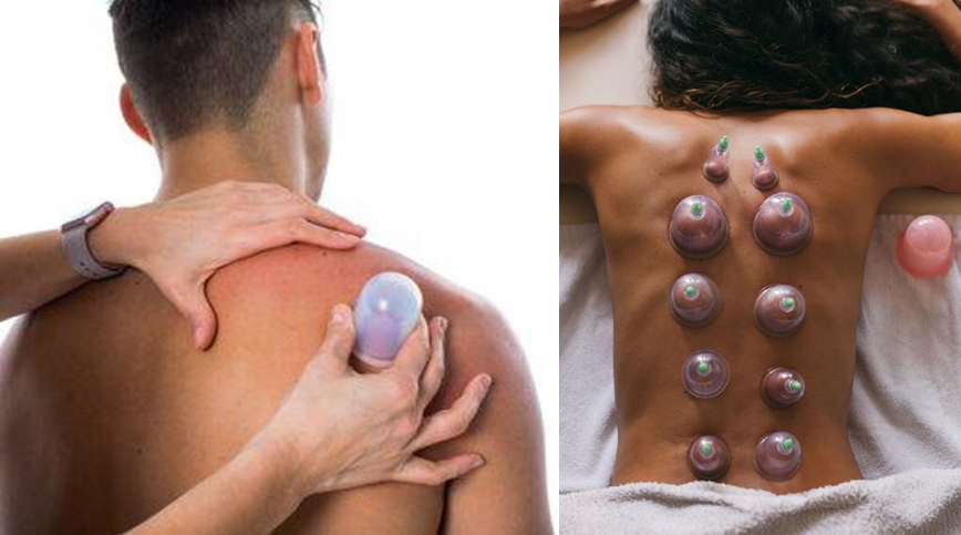 Benefits of Cupping