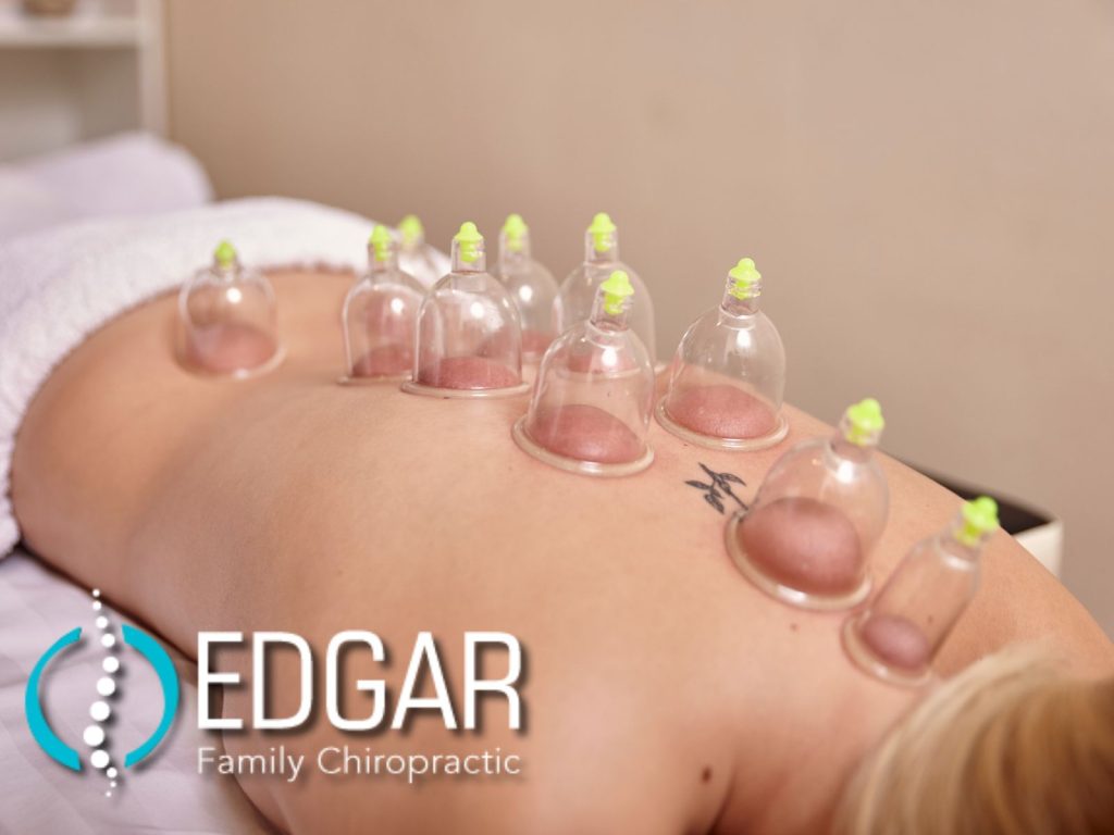cupping therapy