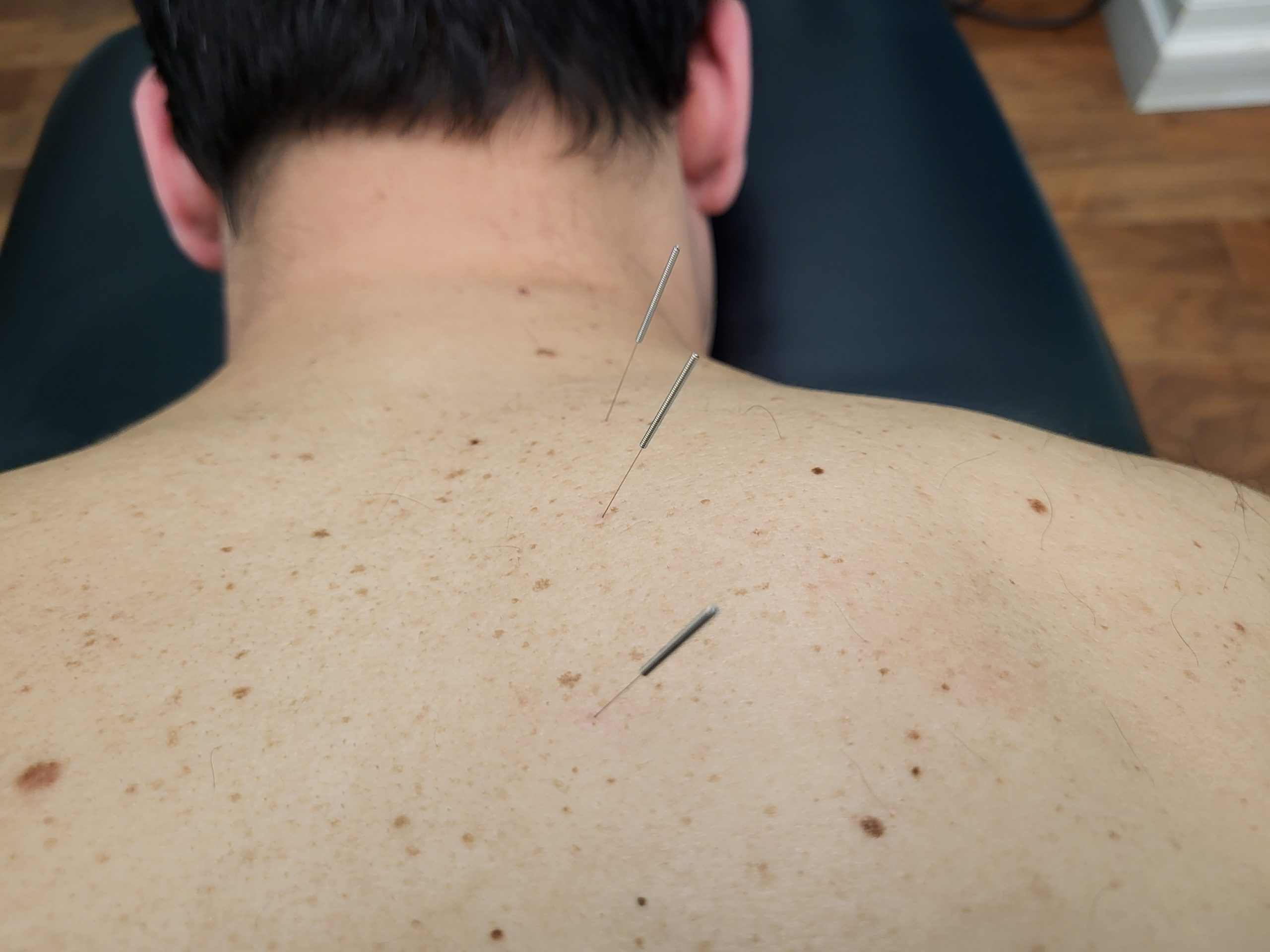 Medical acupuncture needles in a clients back.