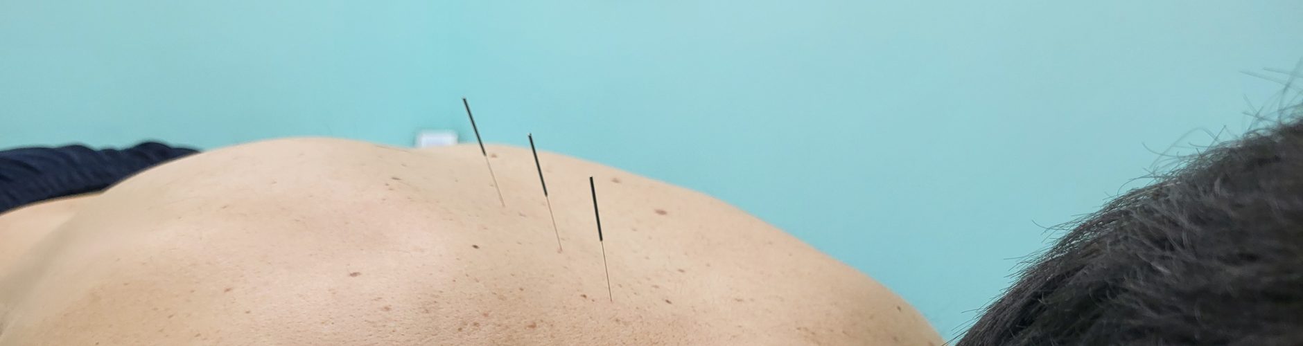 Medical acupuncture needles in a clients back.